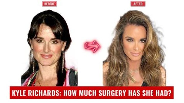 All About RHOBH Kyle Richards Plastic Surgery With Before And After Photos