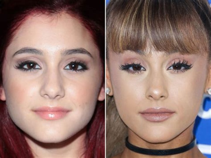 Ariana Madix Nose Job: Before and After Plastic Surgery