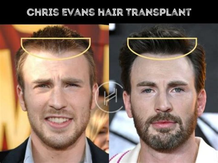 Chris Cuomo Hair Piece and Toupee: Is Chris Bald? Facts on his Hair Replacement and Wig