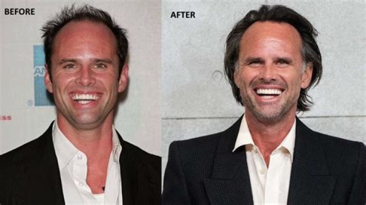 What Happened To Walton Goggins Teeth? A Frenzied Affair Actor’s Face & Health Update